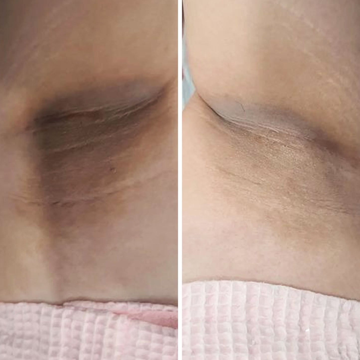 Underarm Brightening