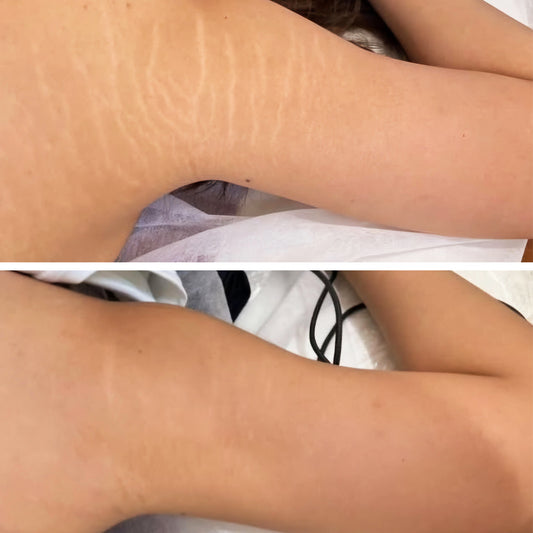 Inkless Stretch Mark  & Scar Rejuvenation