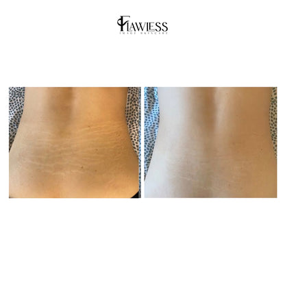 Inkless Stretch Mark  & Scar Rejuvenation
