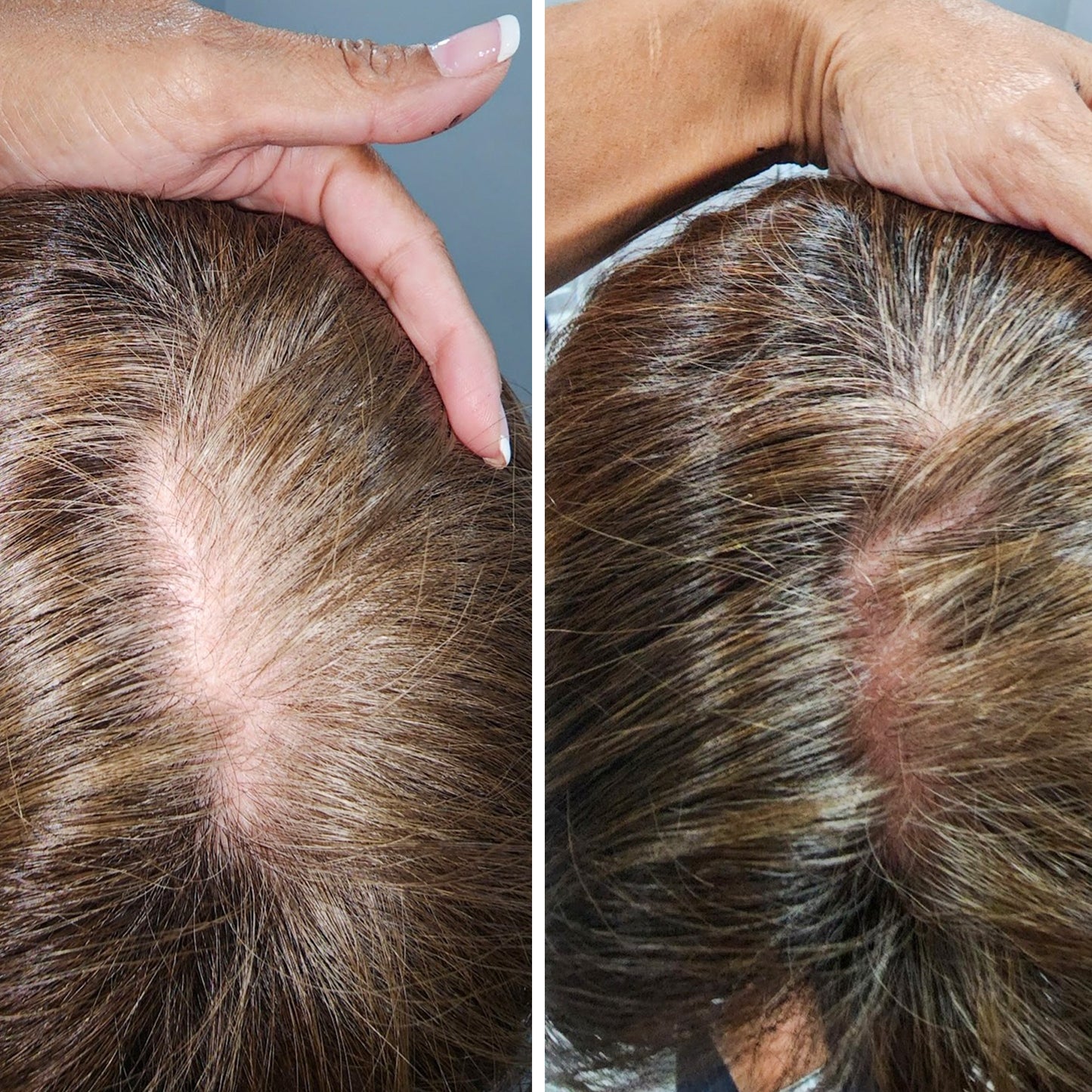 PRP Hair Restoration